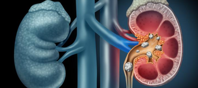 Mini-PCNL Surgery for Kidney Stones by Dr Uday Bhaskar in JP Nagar Bangalore