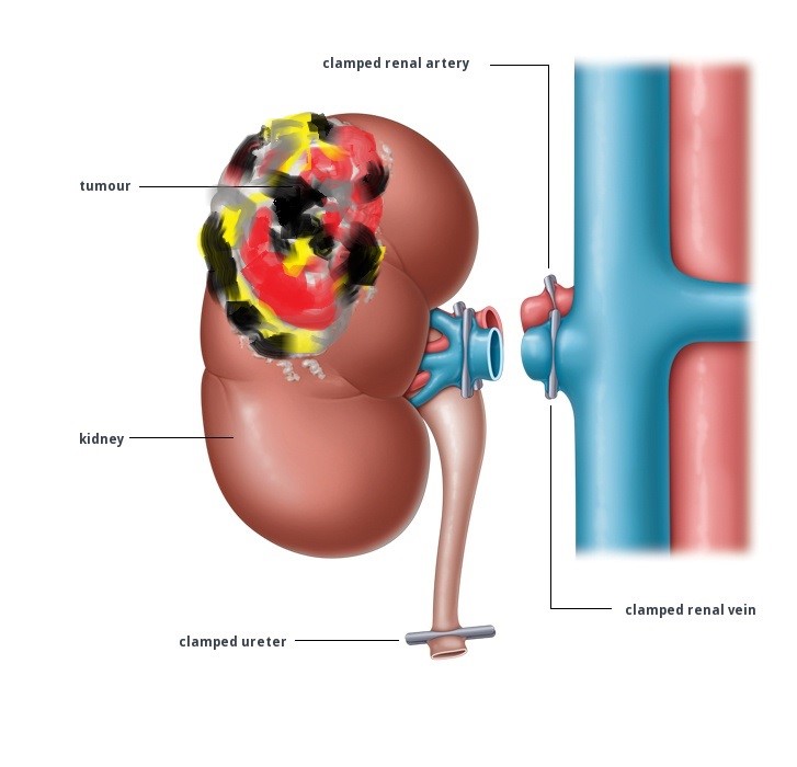 Radical Nephrectomy Surgery by Dr Uday Bhaskar in JP Nagar Bangalore