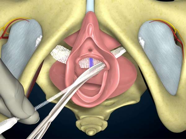TVT Surgery for Stress Urinary Incontinence by Dr Uday Bhaskar in JP Nagar Bangalore