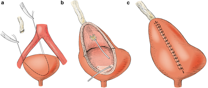 Boari Flap Procedure for Ureteral Reconstruction by Dr Uday Bhaskar in JP Nagar Bangalore