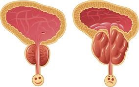 Prostate Enlargement BPH Treatment by Dr Uday Bhaskar in JP Nagar Bangalore
