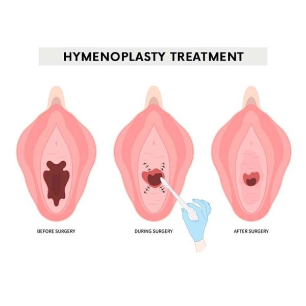 Hymenoplasty Surgery by Dr Uday Bhaskar in JP Nagar Bangalore