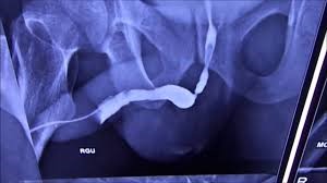 Urethral Stricture Treatment by Dr Uday Bhaskar