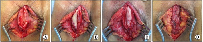 Urethroplasty Surgery by Dr Uday Bhaskar