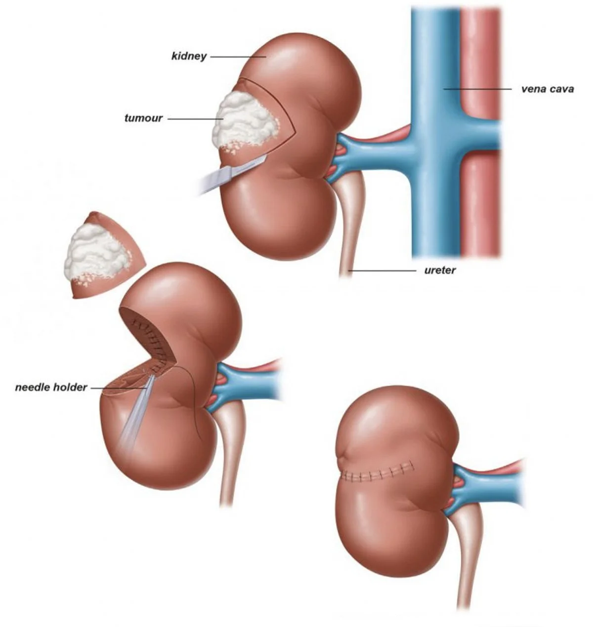 Robotic Partial Nephrectomy by Dr Uday Bhaskar in JP Nagar Bangalore
