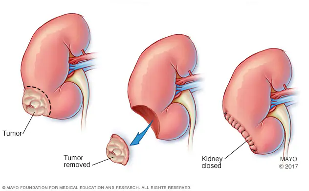 Partial Nephrectomy Surgery by Dr Uday Bhaskar in JP Nagar Bangalore