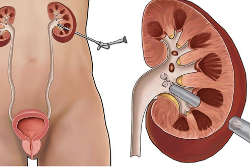 PCNL Surgery for Large Kidney Stones by Dr Uday Bhaskar in JP Nagar Bangalore