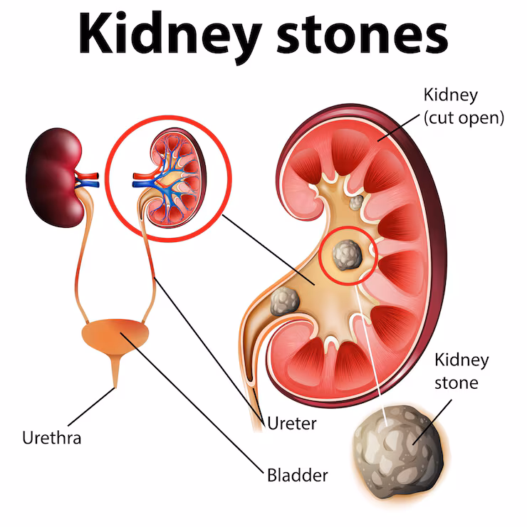 Kidney / Renal Stones Treatment by Dr Uday Bhaskar in JP Nagar Bangalore