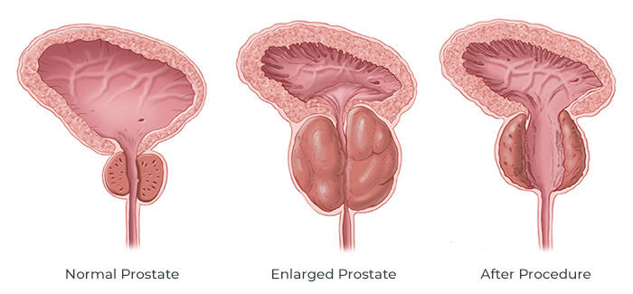 Laser TURP Transurethral Resection of Prostate by Dr Uday Bhaskar in JP Nagar Bangalore