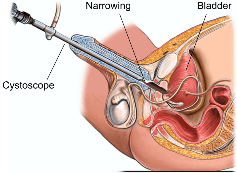 VIU Laser Visual Internal Urethrotomy by Dr Uday Bhaskar