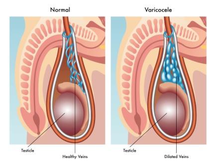 Varicocelectomy Surgery for Varicocele by Dr Uday Bhaskar in JP Nagar Bangalore